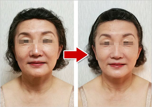 フェイシャルビフォーアフター