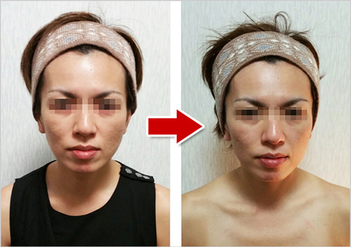 フェイシャルビフォーアフター